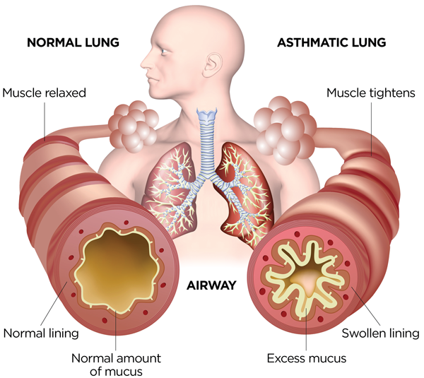 What an asthmatic lung looks like