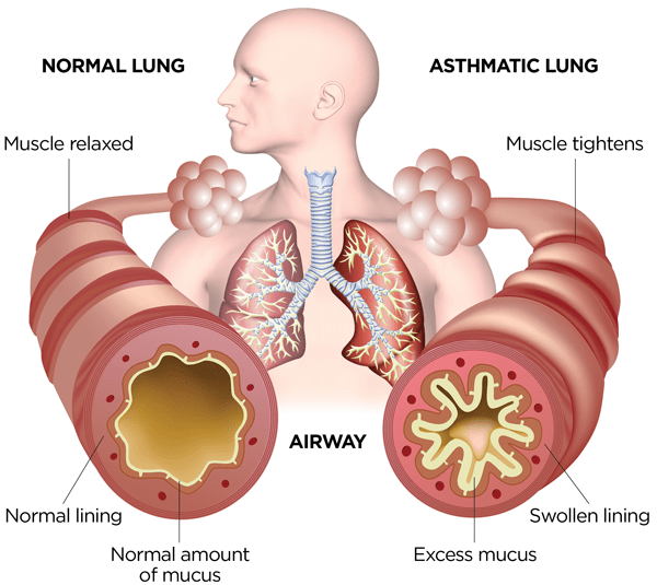 What an asthmatic lung looks like